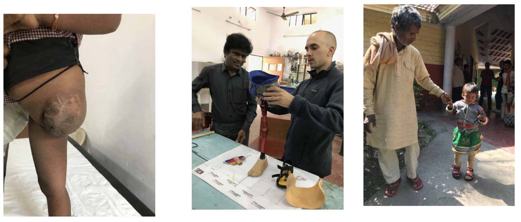 Prosthesis fitting: From casting the residual limb to the precise manufacturing in the workshop to the successful standing and walking.